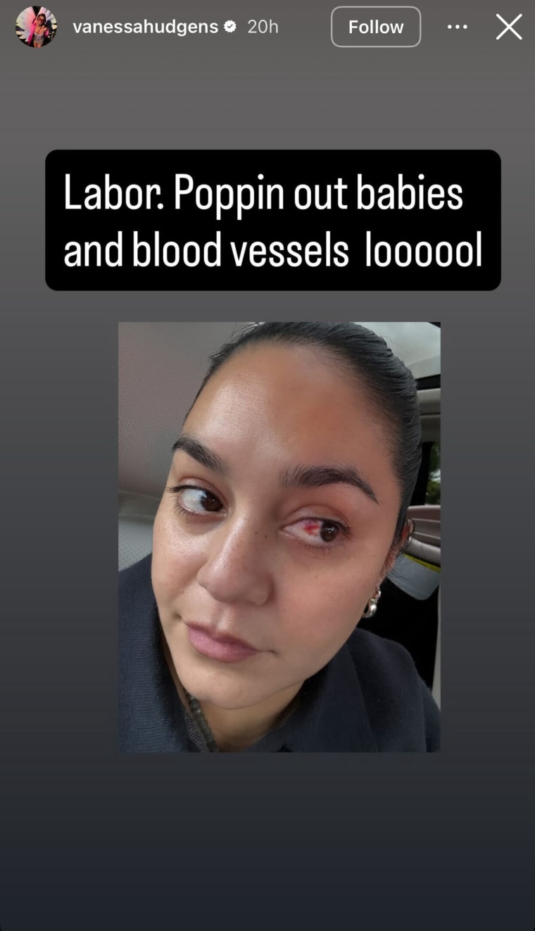 Vanessa Hudgens shared a selfie featuring a popped blood vessel in her eye.